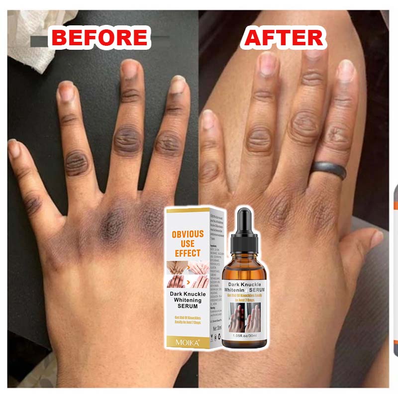 ✅Dark Knuckle Serum (100% Guarantee)