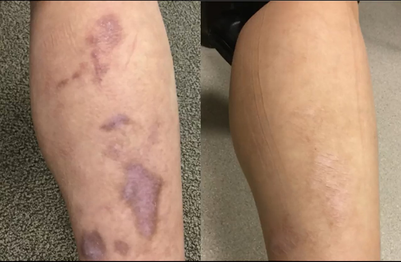 ✅ दाग , धर्सा १००% ग्यारन्टीको साथ हटाउने क्रिम - Stretch Mark Removing Cream 50ml